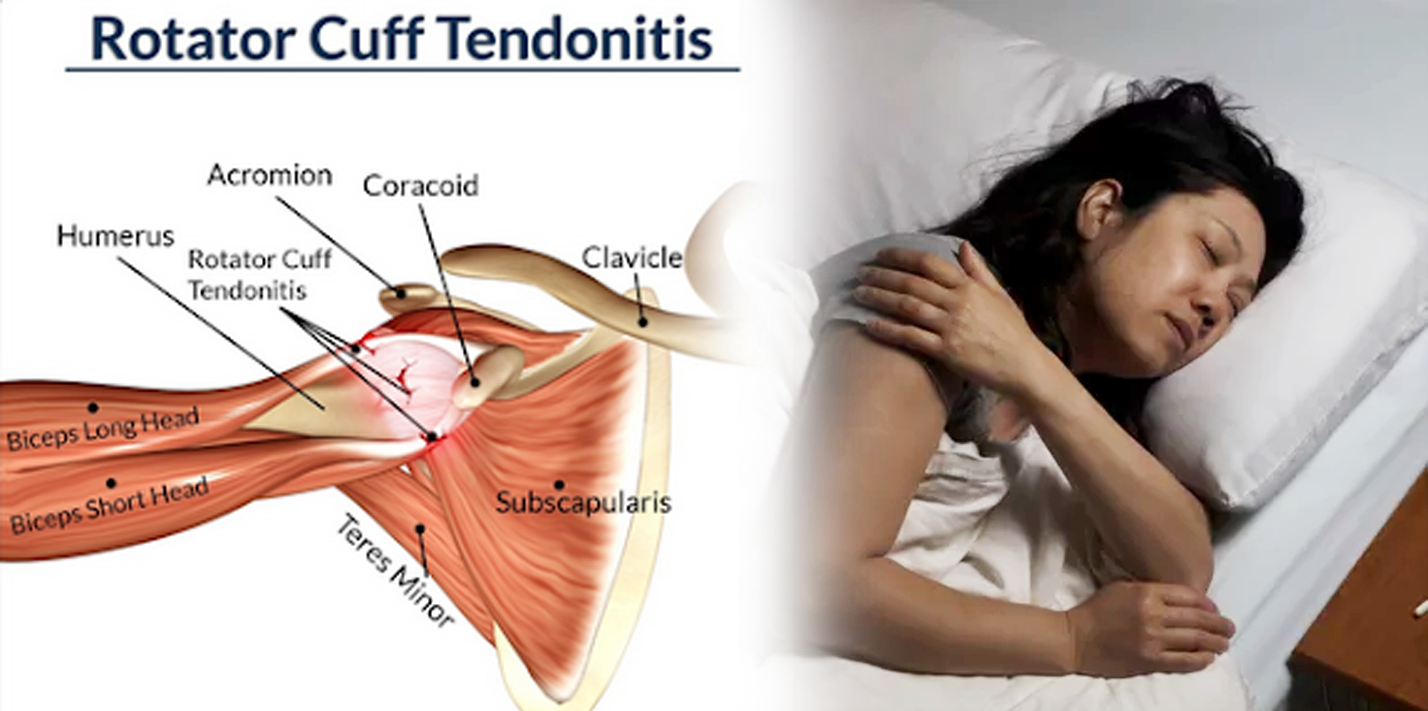 Bahaya Cedera Rotator Cuff Dapat Mengganggu Kualitas Tidur